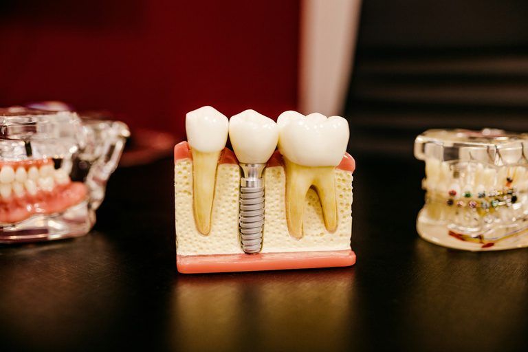 Kiek kainuoja visų dantų atkūrimas ant implantų Panevėžyje?